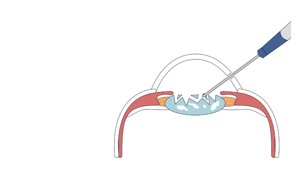  Cataract Surgery