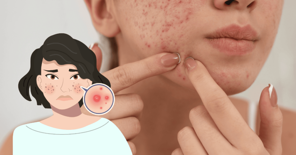 How to Get Rid of Cystic Acne Effective Treatments